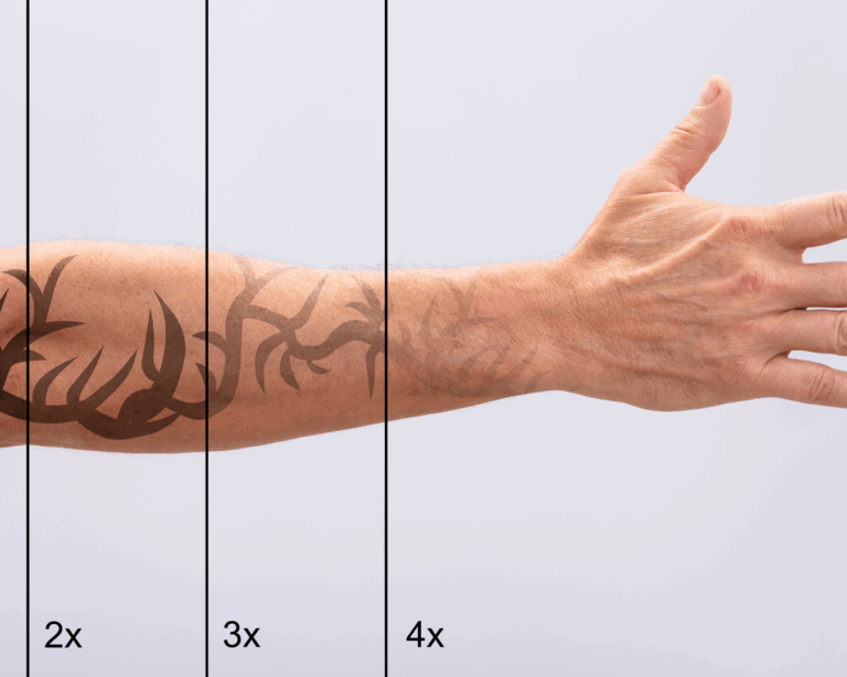 remoção de tatuagem a laser em Curitiba na THA Dermatologia com Fotona Starwalker
