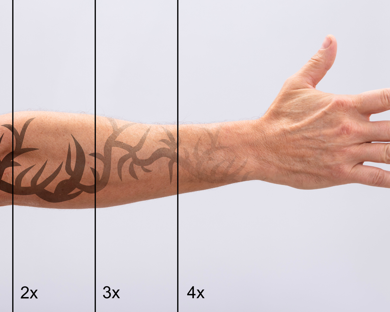 remoção de tatuagem a laser em Curitiba na THA Dermatologia com Fotona Starwalker