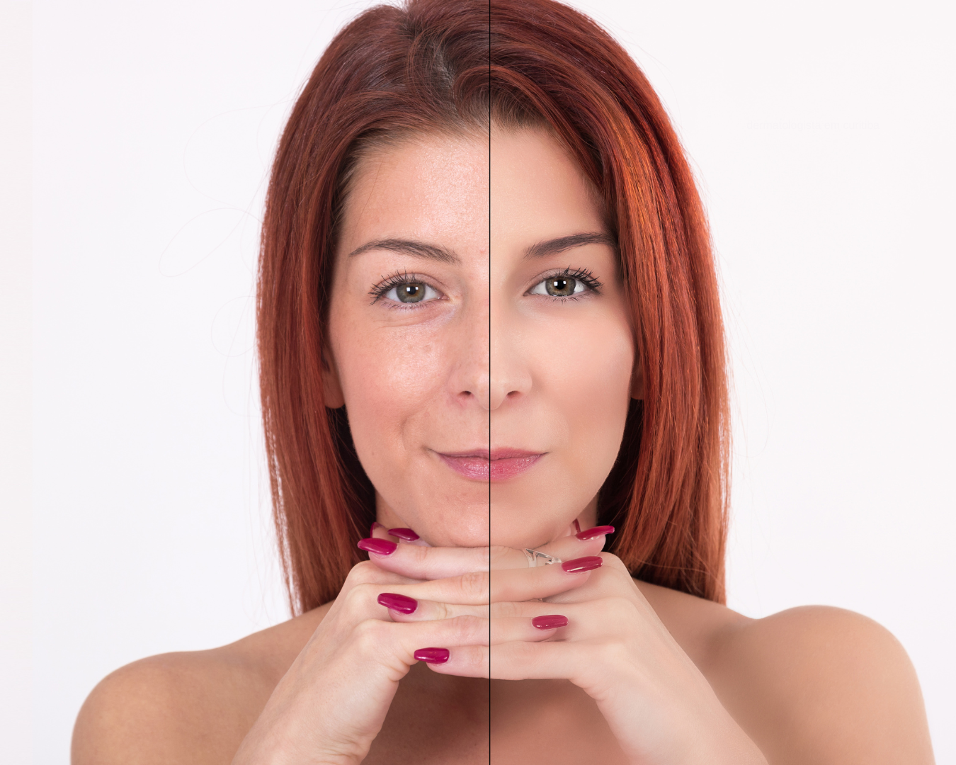 Tratamento com Fotona 4D para rejuvenescimento facial