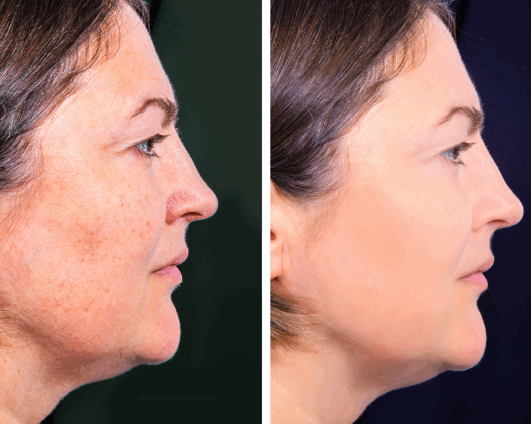 Aplicação do laser Fotona Starwalker para manchas e tatuagens em Curitiba na THA Dermatologia