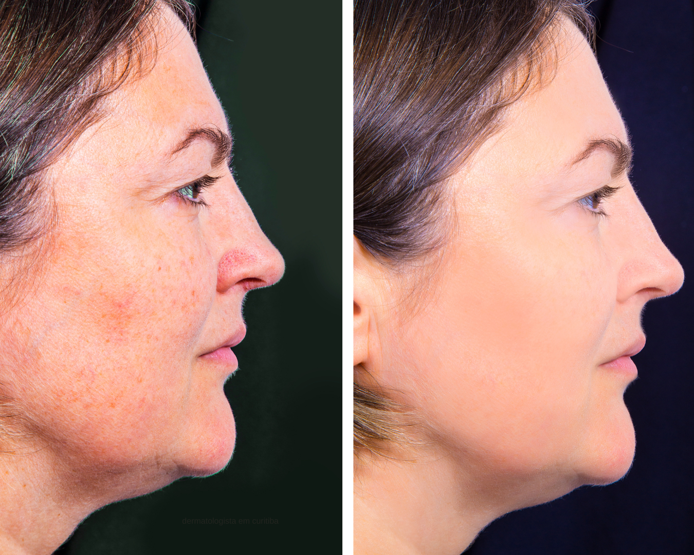 Aplicação do laser Fotona Starwalker para manchas e tatuagens em Curitiba na THA Dermatologia