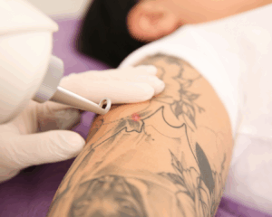 Procedimento de remoção de tatuagem a laser em Curitiba com Fotona Starwalker