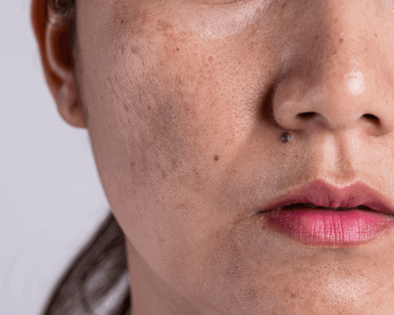 Tratamento para melasma em Curitiba na THA Dermatologia com tecnologias avançadas