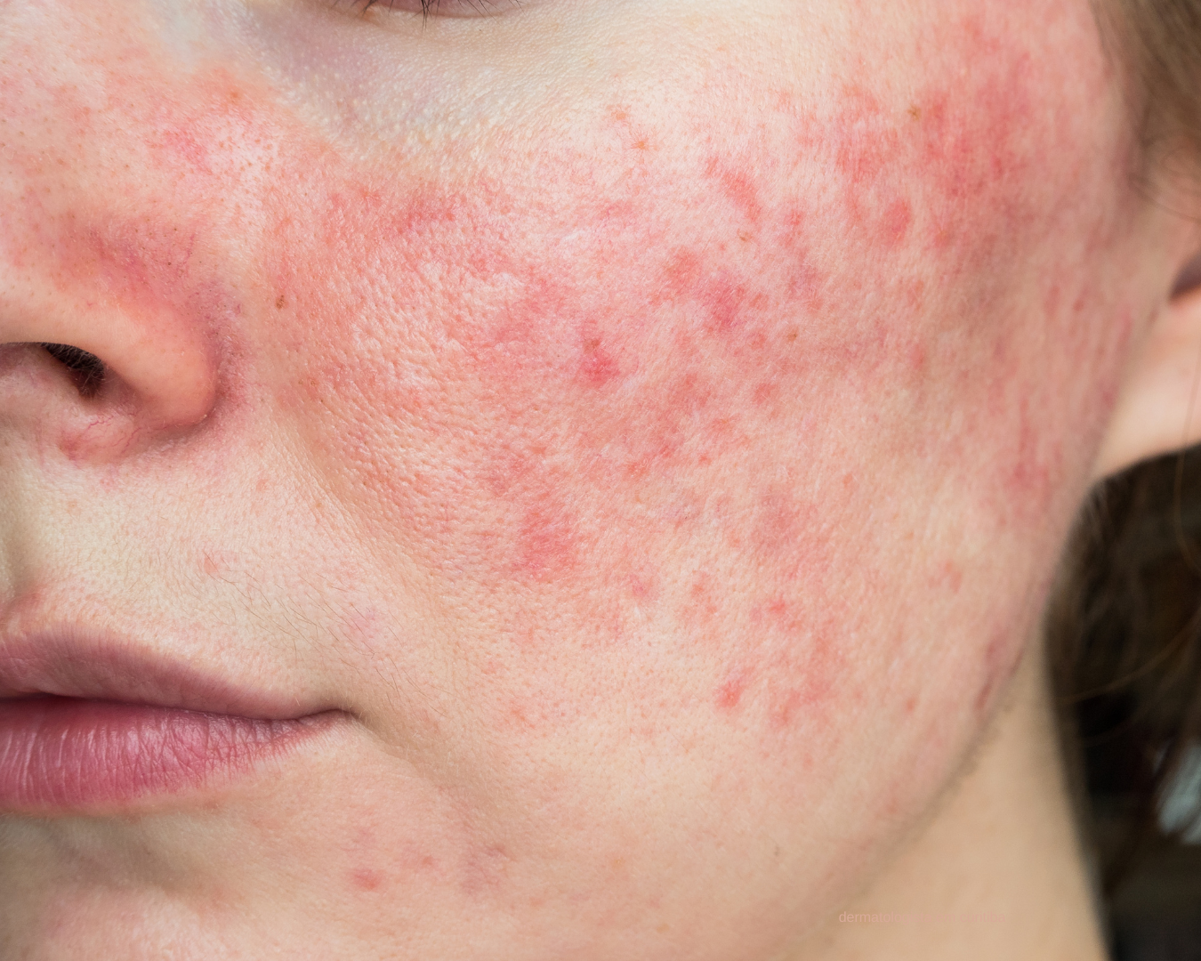 Tratamento para rosácea em Curitiba com tecnologias modernas na THA Dermatologia