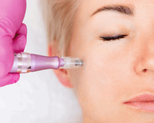Microagulhamento facial em Curitiba