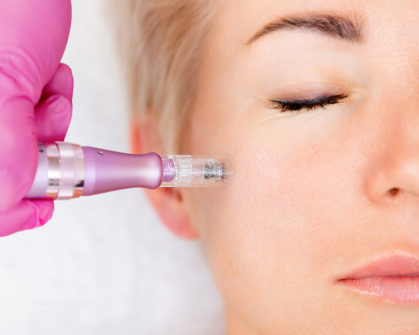 Microagulhamento facial em Curitiba